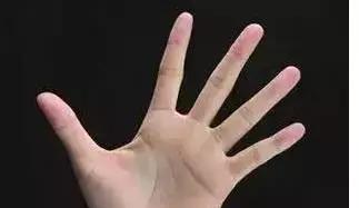 脑血栓怎么活血化瘀,脑血栓怎么防止肩膀下垂