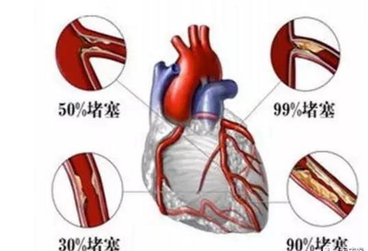 中医治疗心脑血管站桩,练太极站桩对心脑血管有帮助吗