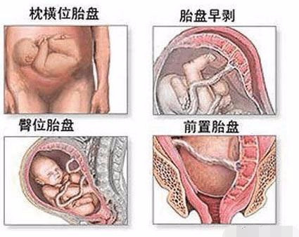剖腹产手术全过程图解，需要切开7层才能将宝宝取出