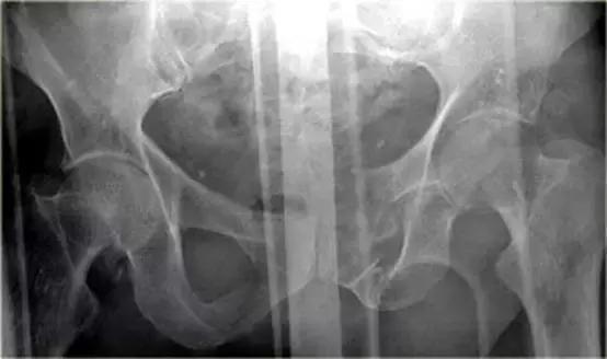 腹腔脏器炎症ct可以查出来吗,膀胱创伤的诊断方法