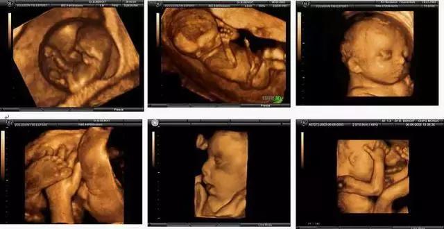 普通b超和彩超哪个辐射小点,普通的彩超和孕妇b超有区别吗