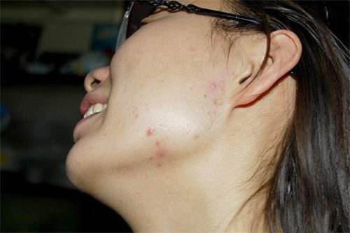 成人痘最佳治疗方法,成人痘痘不留疤痕祛除法