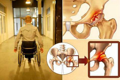 股骨头关节置换手术后多久能痊愈,股骨头人工关节置换有什么后遗症