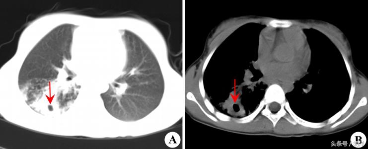 肺部肉芽肿和肿瘤几率各一半,肺上长脓包是个严重的病吗