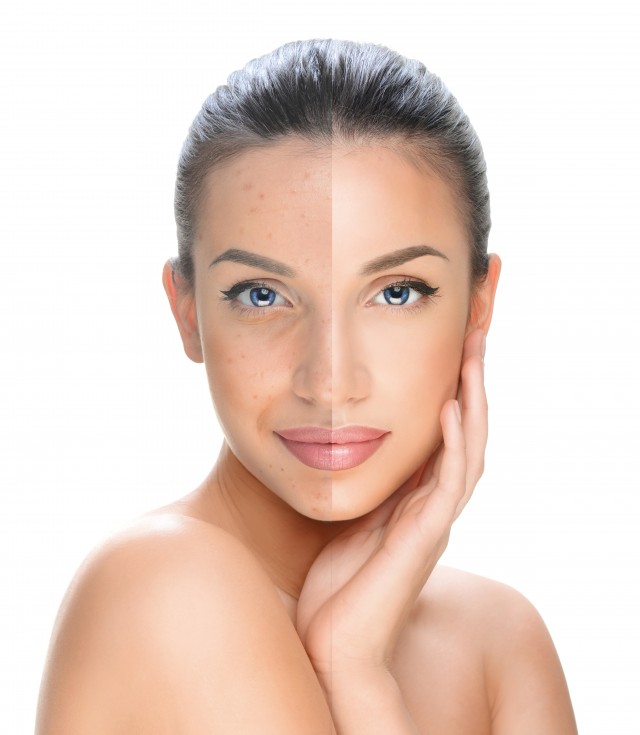 额头油脂粒涂什么药膏,额头毛孔有油脂粒怎么消除