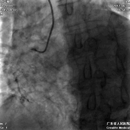 冠脉介入术的介绍,复杂冠脉介入病例