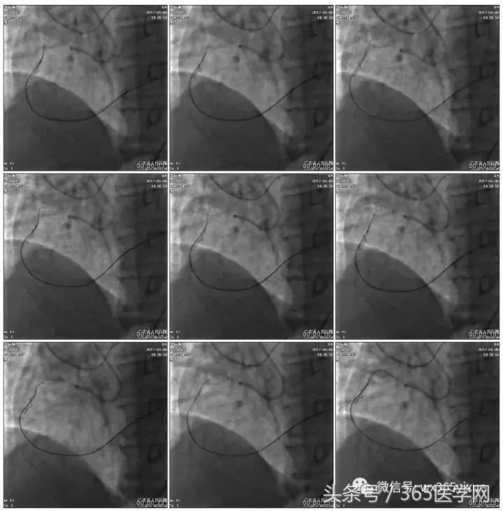 冠脉介入术的介绍,复杂冠脉介入病例