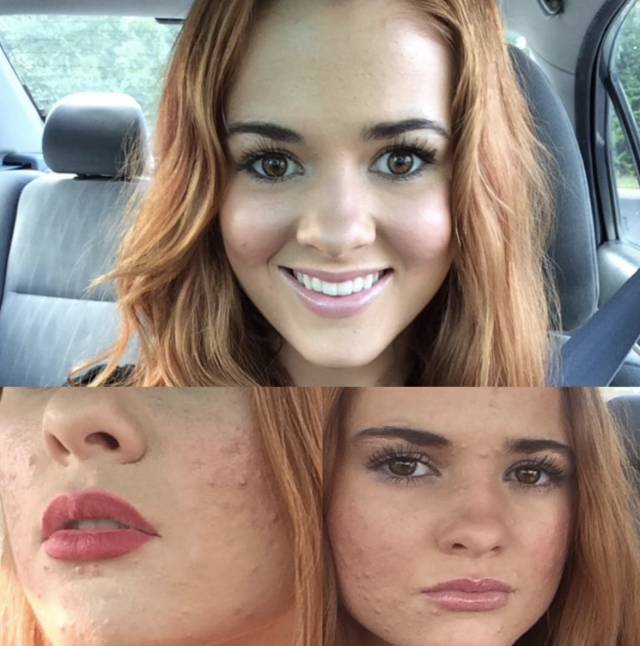 360°真实记录从满脸痘到痊愈，她红遍了Ins