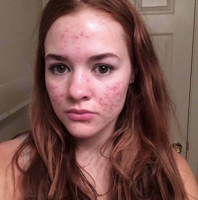 360°真实记录从满脸痘到痊愈，她红遍了Ins