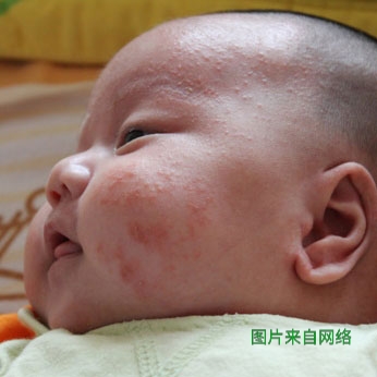 宝宝得了湿疹可以打疫苗吗,得了湿疹有什么症状