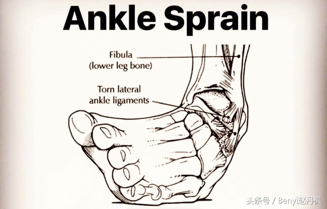 脚踝伤病的六个问题,脚踝受伤康复训练篮球