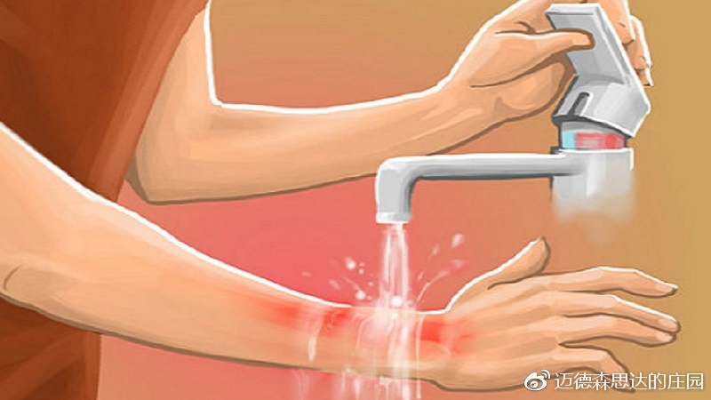 烧伤正确处置流程,烧伤怎么调理心态