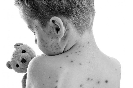 冬春季节高发病水痘的预防治疗,水痘患儿应避免使用什么药物