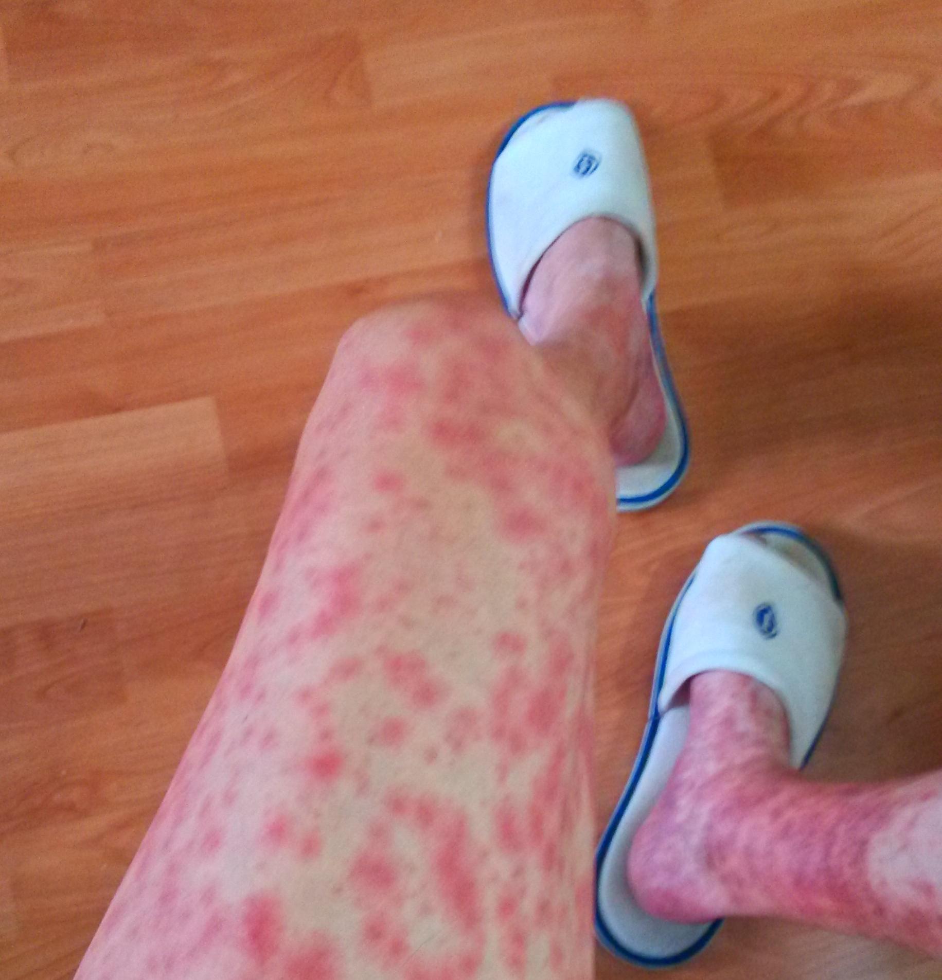 中美肿瘤治愈率,中美联手攻克乙肝能实现吗