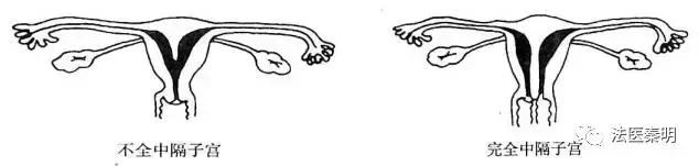 女人有两个子宫怎么办呢,来大姨妈可以同宫吗