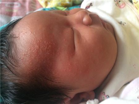 宝宝得了湿疹怎么解决,宝宝得湿疹严重怎么办