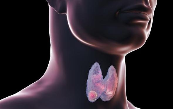 快被癌症家族扫地出门的甲状腺癌：高发却温和10年存活率可达90%