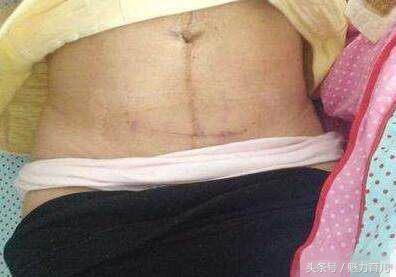 顺产是不是比肚子还痛,顺产撕裂加侧切和剖腹产比哪个好