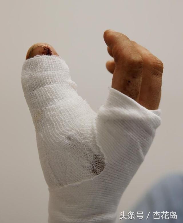 被人咬伤要不要处理,被人咬伤了怎么处理