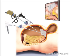哪些情况做腹腔镜手术,腹腔镜手术的优势及护理课件