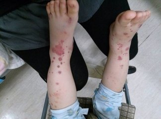 过敏性紫癜反复用什么中药,儿童过敏性紫癜容易复发吗