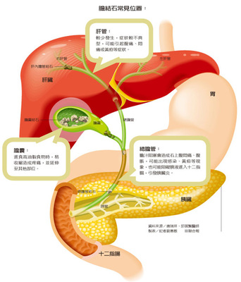 胆结石手术后食疗菜谱窍门大全,泥沙样胆结石食疗秘方10大排行榜