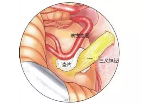 天下第一疼手术是什么,天下第一三叉神经减压术