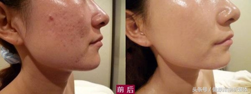 怎样内调才能去掉脸上的斑,怎么才能把脸上的斑纹去掉