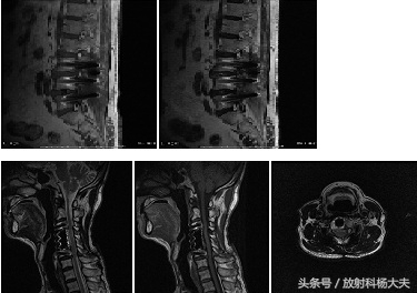 有假牙头部做磁共振有影响吗,有假牙能做核磁共振全过程视频