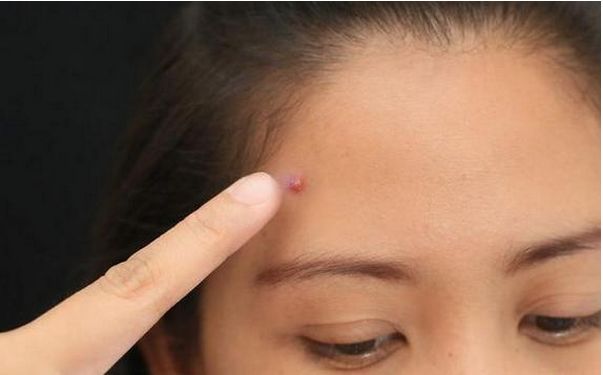 女人外面长什么痘，里面就有什么病！你造吗？