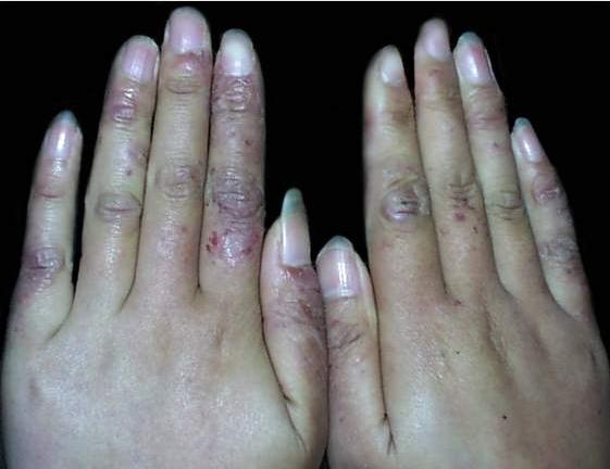 长过冻疮的手都会粗一圈，而且每年都会复发，7个小窍门杜绝复发