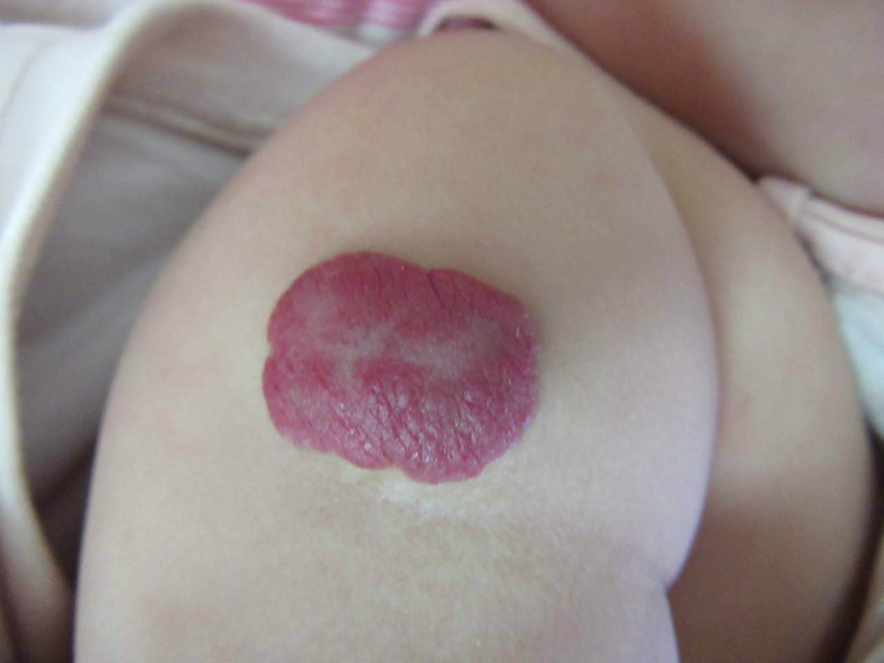 血管瘤六大疗法,颈椎血管瘤用什么中药外用治疗