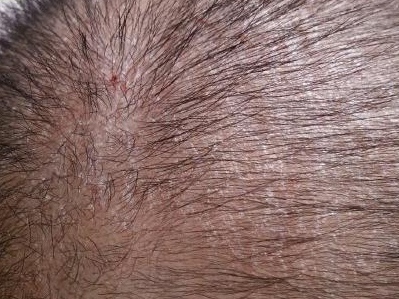 婴儿脸上疹子,婴儿疹子