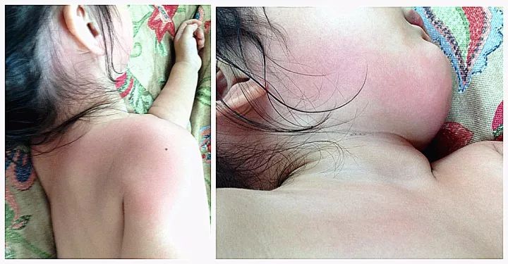 小柴胡怎么是处方药,小柴胡用量用法