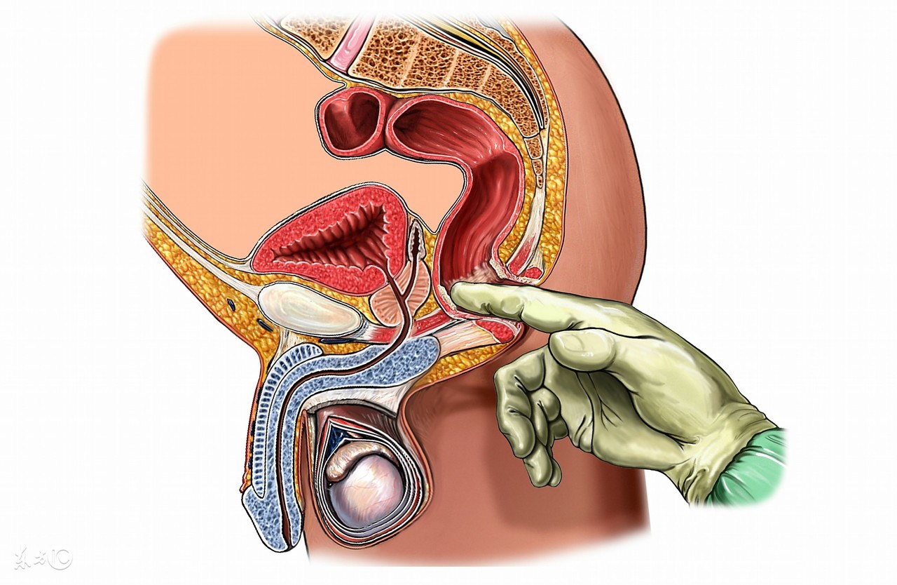直肠癌被误诊为痔疮赔多少,肠镜会不会将直肠癌和痔疮误诊