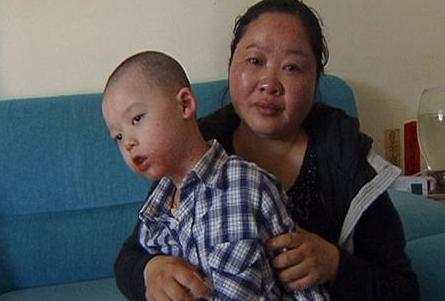 宝宝肤专家可以治疗湿疹吗,一岁半宝宝湿疹怎么治疗