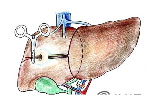 肝癌会传染吗的文章,肝癌会传染吗