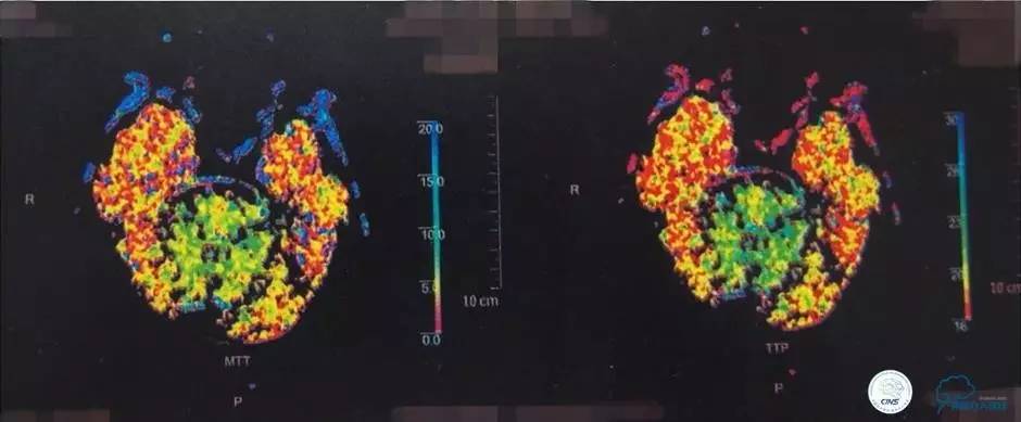 急性缺血性卒中静脉溶栓2018指南,急性缺血性卒中血管内再通标准