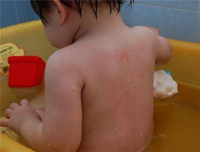 三个月大宝宝湿疹严重怎么护理,新生儿湿疹怎么护理最有效