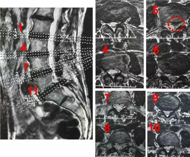 脊柱内镜辅助治疗脱垂游离型腰椎间盘突出1例