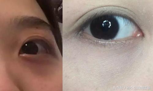 怎样拯救黑眼圈,如何才能拯救我的黑眼圈大眼袋