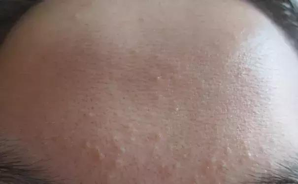 脸上小疙瘩消除最快方法,脸上小疙瘩密密麻麻怎么治疗