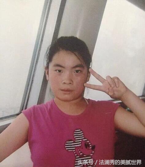 祛斑成功堪比整容,激光祛斑显老