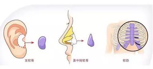 假体隆鼻都有什么术式,假体隆鼻一般用什么材料