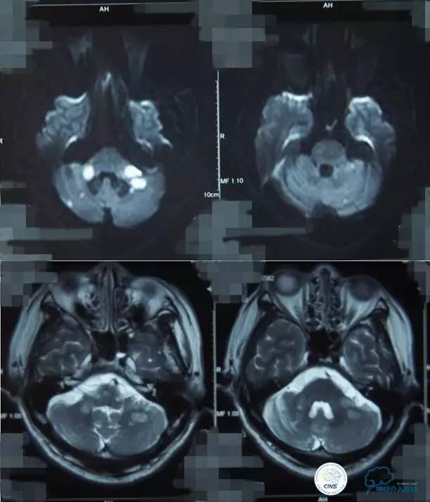 急性缺血性卒中静脉溶栓2018指南,急性缺血性卒中血管内再通标准