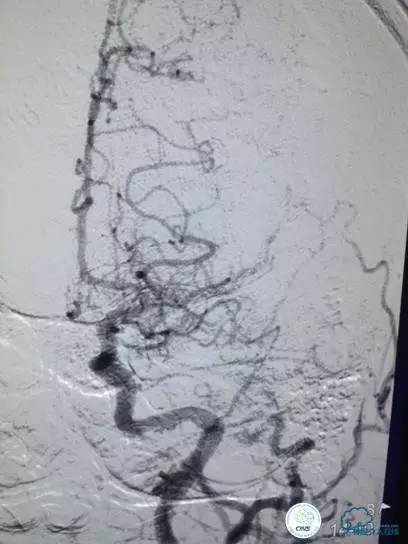 急性缺血性卒中静脉溶栓2018指南,急性缺血性卒中血管内再通标准