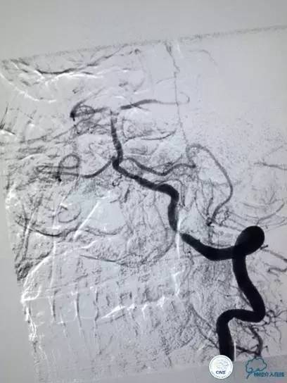 急性缺血性卒中静脉溶栓2018指南,急性缺血性卒中血管内再通标准