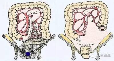 精品原创︱医生，您为什么要让我“挂粪袋”？