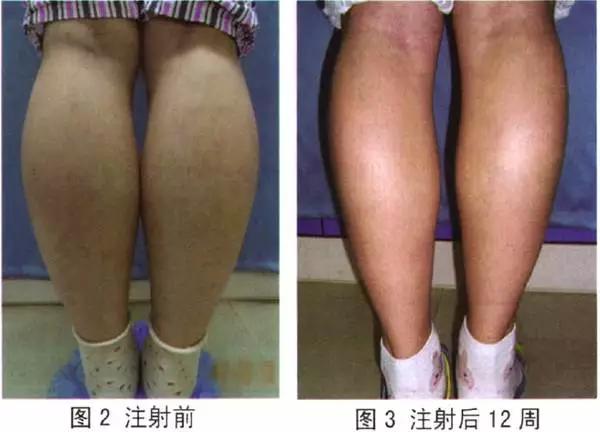 瘦腿针有没有效果,打了瘦腿针走路多影响效果吗
