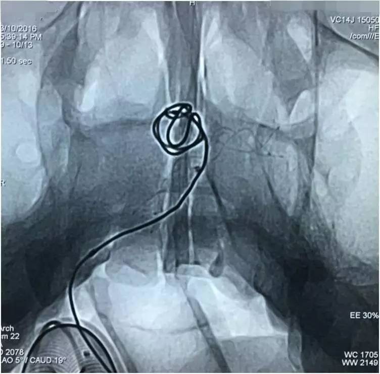基底动脉顶端动脉瘤加左侧小脑上动脉瘤以Y型支架结合弹簧圈栓塞